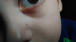 Сгруппированная мелкая сыпь на носу у ребенка фото 1
