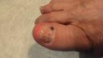 Не проходит гематома под ногтем большого пальца ноги фото 1