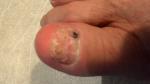 Не проходит гематома под ногтем большого пальца ноги фото 2