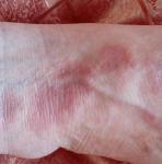 Псориаз без основных симптомов псориаза - зуда и шелушения фото 2