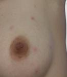 Небольшие гладкие пятна на груди и в подмышках фото 2