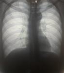 Пневмония ли на рентгене? фото 1
