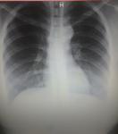 Пневмония ли на рентгене? фото 2