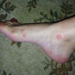 Красные высыпания на коже ног и рук, похожие на комариные фото 2