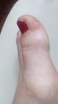 Около ногтя на ноге появились неприятные пупырышки, покраснение фото 2