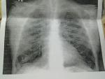 На сколько точно рентген видит пневмонию фото 1