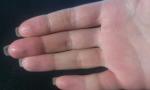 Сухость и трещины на подушечках пальцев одной руки фото 1