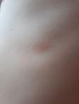 Бледно-розовое пятно у ребенка 3 лет фото 1