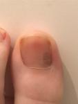 Бледное темно-коричневое пятно на большом пальце ноги фото 2