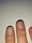 Проблемы с ногтевой пластиной фото 1