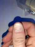 Проблемы с ногтевой пластиной фото 2