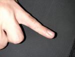Небольшие волдыри на пальцах рук (без зуда) фото 1