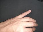 Небольшие волдыри на пальцах рук (без зуда) фото 2