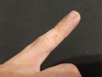 Небольшие волдыри на пальцах рук (без зуда) фото 4
