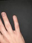 Небольшие волдыри на пальцах рук (без зуда) фото 3