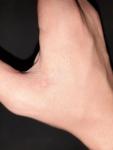 Небольшие волдыри на пальцах рук (без зуда) фото 5