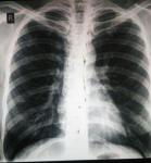 Сухой кашель, рентген легких, туберкулез фото 1