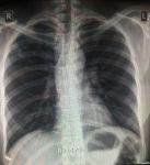 Сухой кашель, рентген легких, туберкулез фото 2