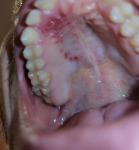 Красные пятна на нёбе язвочка над зубами фото 1