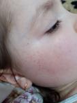 Сыпь на лице у ребенка, что такое фото 1