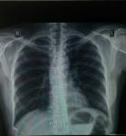 Рентген легких, очаги, туберкулез фото 1