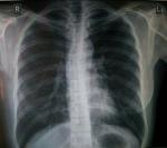 Рентген легких, очаги, туберкулез фото 2