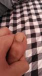 Потеря чувствительности пальца на ноге фото 2
