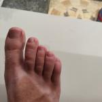 Зуд пальца ноги фото 1