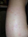 Красные пятна на руках и ногах (есть подозрения на аллергию) фото 1
