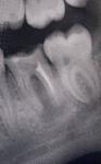 Воспаление десны, разрушенный зуб фото 1