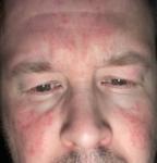 Зуд жжение покрраснение фото 4