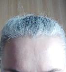 Плоска на лбу фото 1