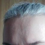 Западение вены на лбу фото 3