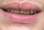 Уплотнение внутри губы после рассечения фото 1