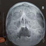 Тема: Исследование придаточных пазух носа фото 1