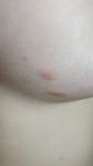 Красные высыпания на груди при беременности фото 3