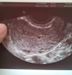Беременность 3 недели фото 2