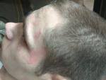 Шелушение пятнами на лице и в волосах фото 1