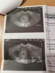 Яичниковая беременность +маточная фото 2