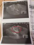 Яичниковая беременность +маточная фото 1