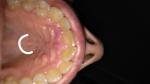 Воспаление около передних зубов фото 1