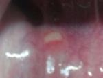 Стоматит с внутренней стороны губы фото 2