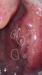 Налет на миндалинах без боли в горле после ангины фото 2