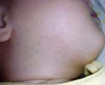 Сыпь и сухие пятнышки грудничка фото 2