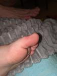 Кожное уплотнение на пальце ноги у ребенка фото 1