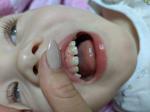 Жёлтая эмаль ребенка верхних зубов фото 3