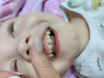Жёлтая эмаль ребенка верхних зубов фото 2