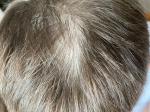 Отсутствие волос на голове ребенка фото 3