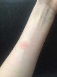 Розовая шелушащаяся болячка на руке фото 3