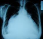 Сердце рентген диагноз фото 1